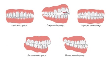 Виды прикусов